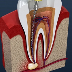 A diagram of a root canal