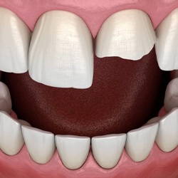 Image of a chipped front tooth.