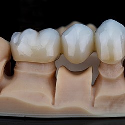 A dental bridge