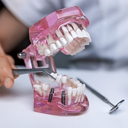 A dentist showing an implant bridge