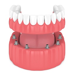 implant-retained bridge