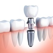 Diagram of the different parts of dental implants in Calimesa