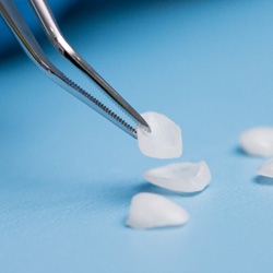 Close-up of veneers in Calimesa 