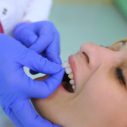 Calimesa patient getting veneers