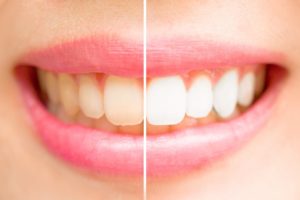 A smile before and after teeth whitening.