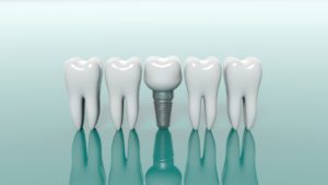  dental implants in Calimesa next to molars