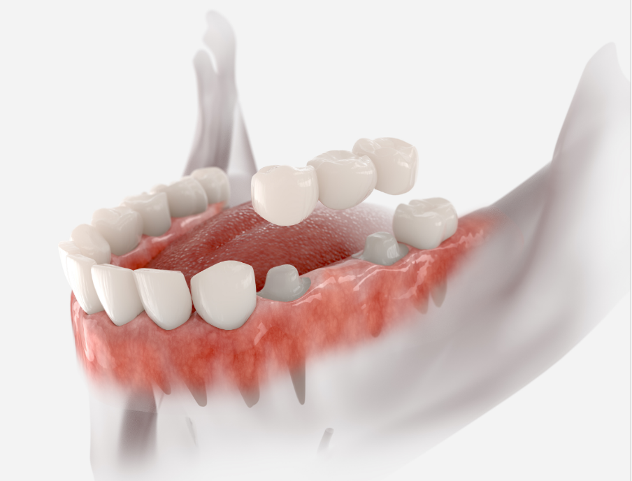Illustration of a dental bridge